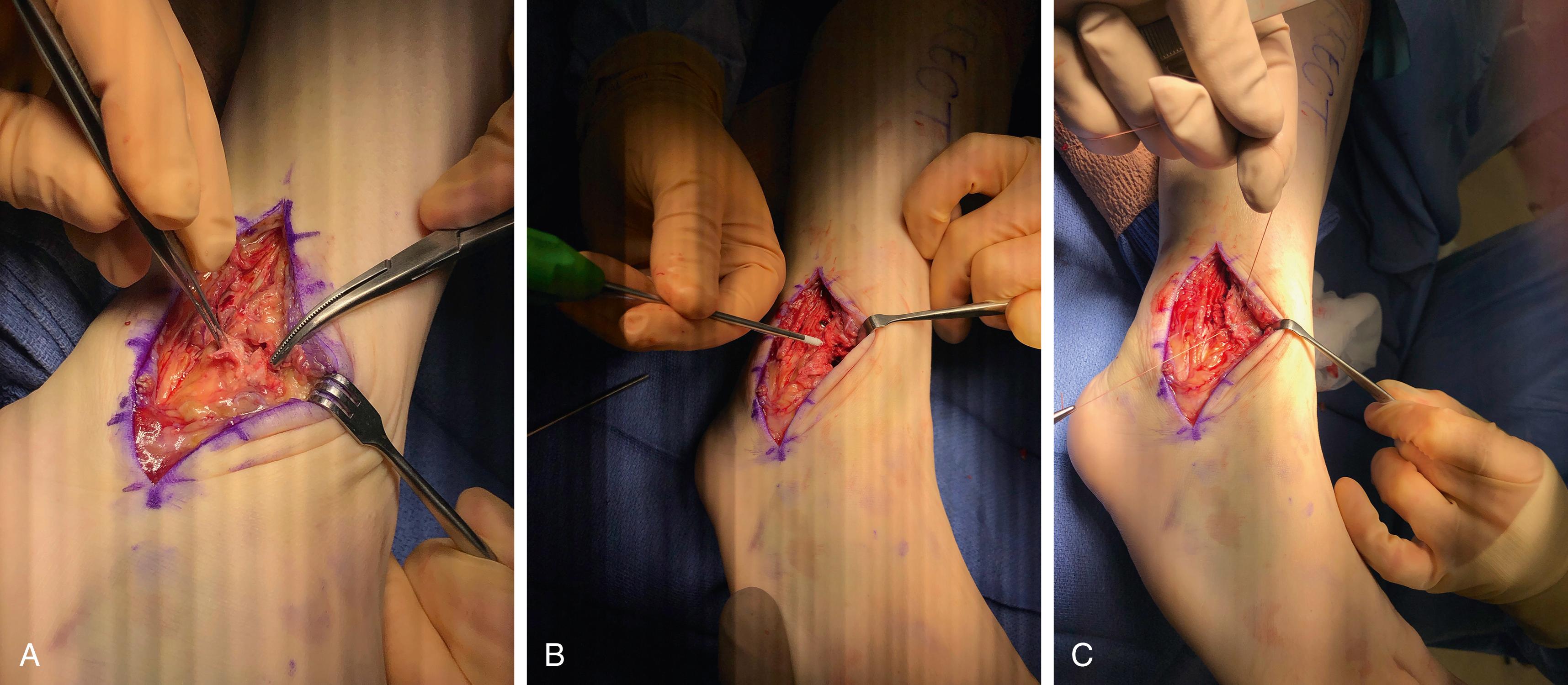 FIGURE 90.19, A and B , Stabilization of syndesmosis with repair of the anterior talofibular ligament. C , Primary anatomic repair.