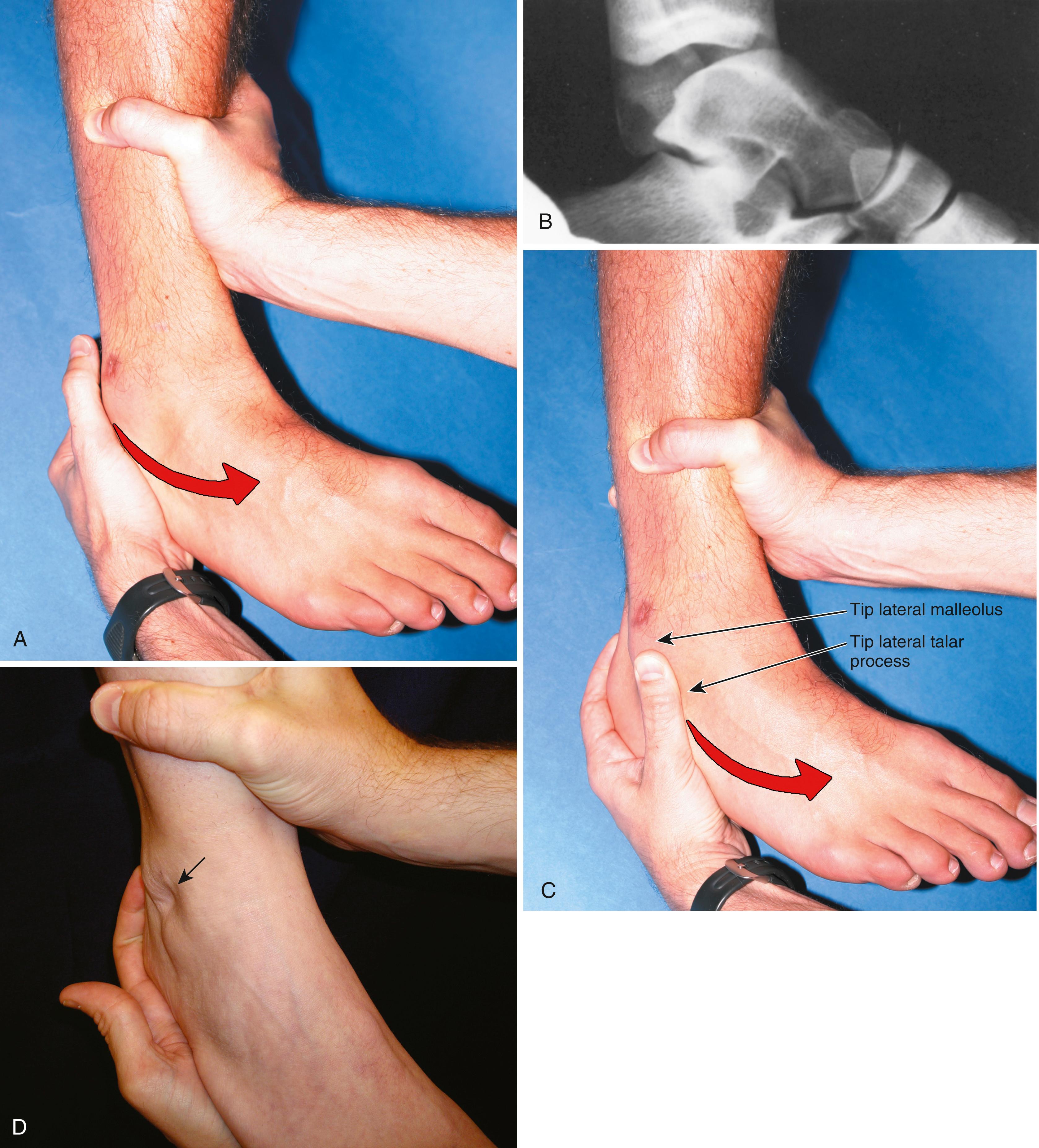 FIGURE 90.5, A, Demonstration of anterior drawer sign positioning for radiograph. B, Positive anterior drawer test. C, Clinical demonstration of anterior draw sign. D, Sulcus, or suction, sign (arrow) indicating disruption of the anterior talofibular ligament.