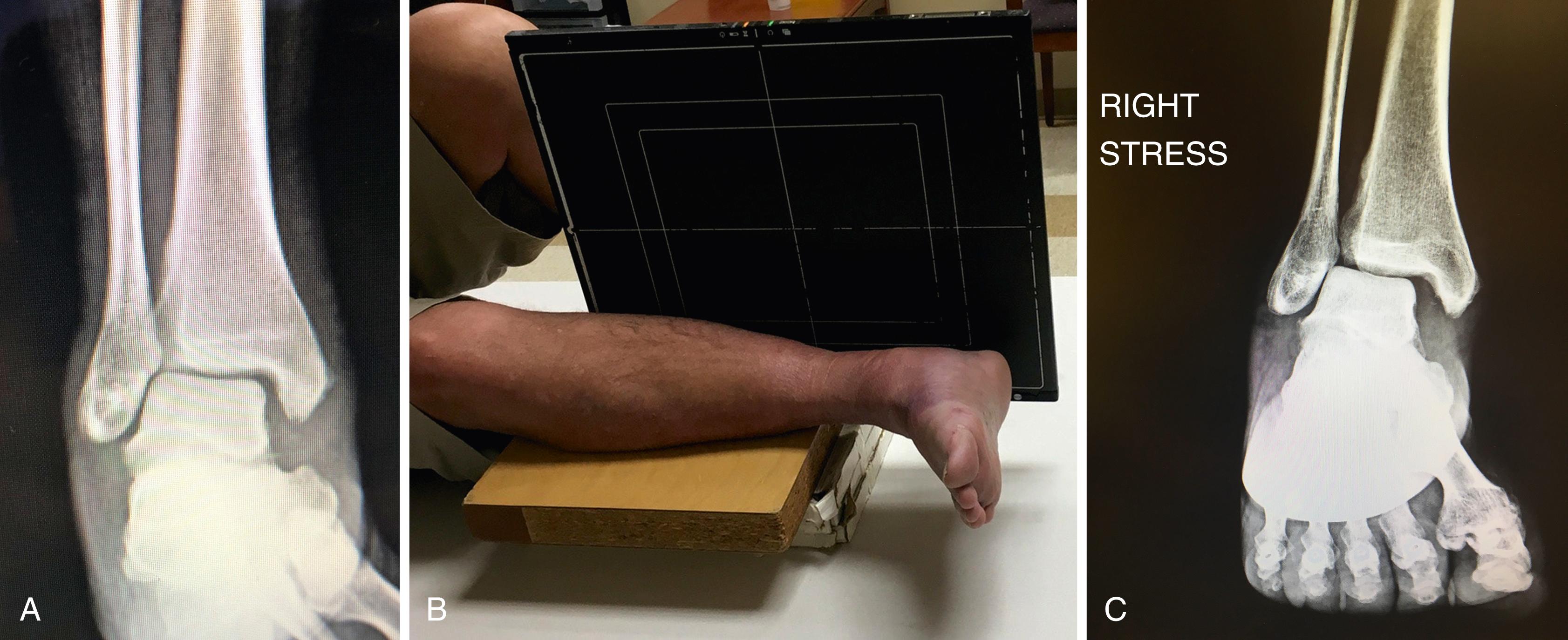 FIGURE 90.6, A, Non–weight bearing standard mortise view of ankle. B, Limb placed over bolster with distal third of leg off the table, with cassette positioned for a cross table lateral image, allowing external rotation stress of mortise (C).