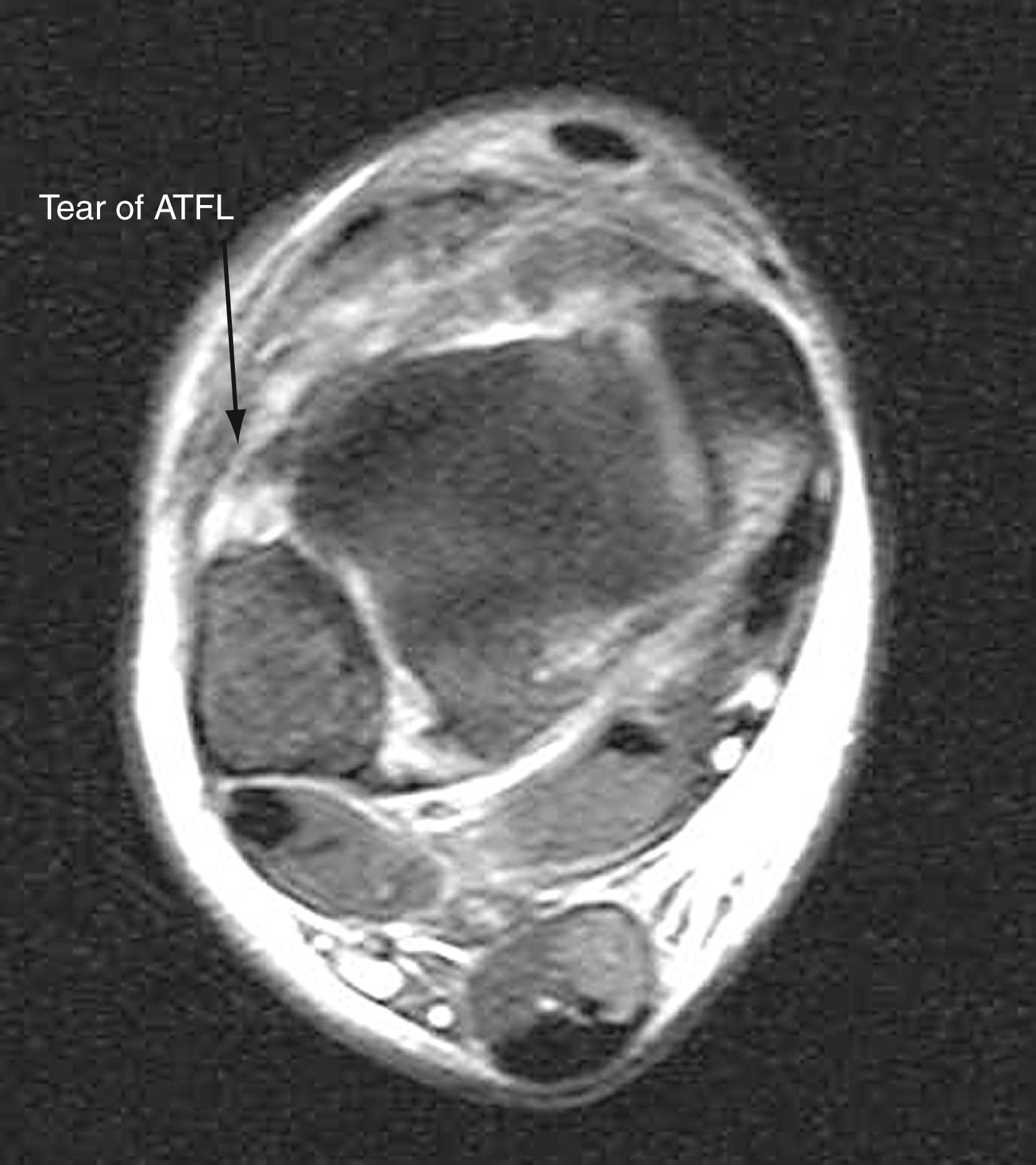 FIGURE 90.7, MRI of patient with syndesmosis injury; note tear of the anterior tibiofibular ligament (arrow).