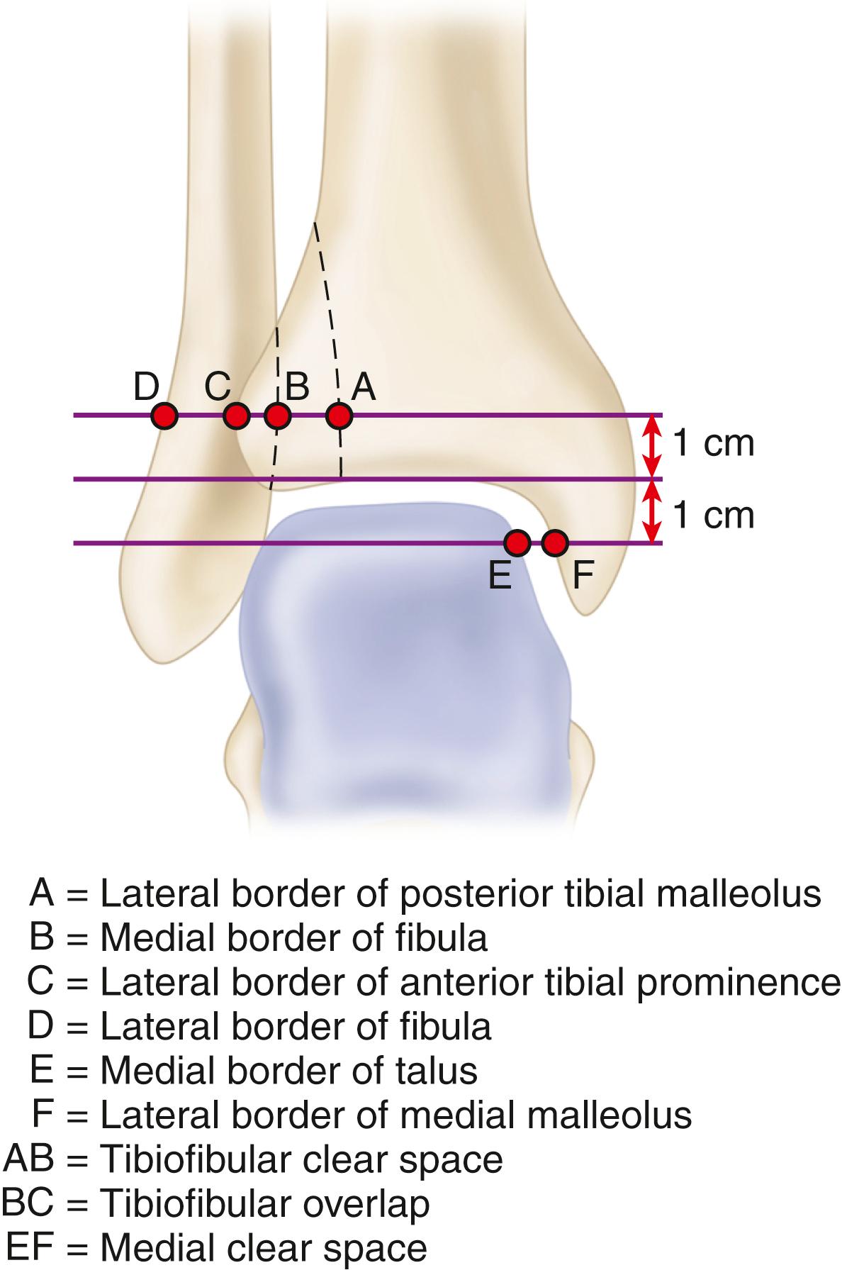 FIGURE 90.8, Radiographic relationships important in evaluating tibiofibular articulation. Line EF represents medial clear space; line AB represents tibiofibular clear space.