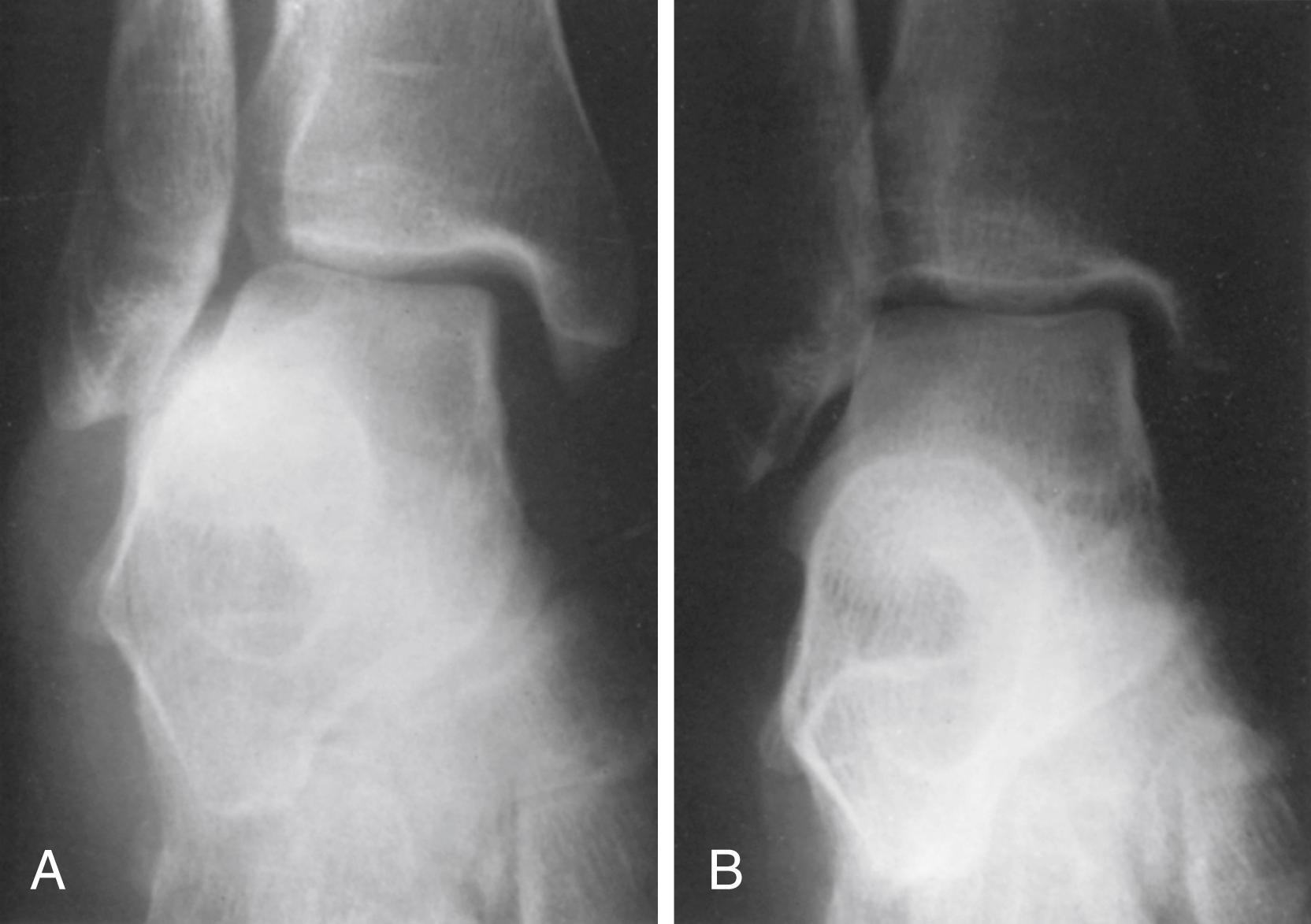 FIGURE 90.9, A, Acute tear of deltoid ligament with oblique fracture of fibula and lateral shift of talus in ankle mortise. B, After repair of deltoid ligament.