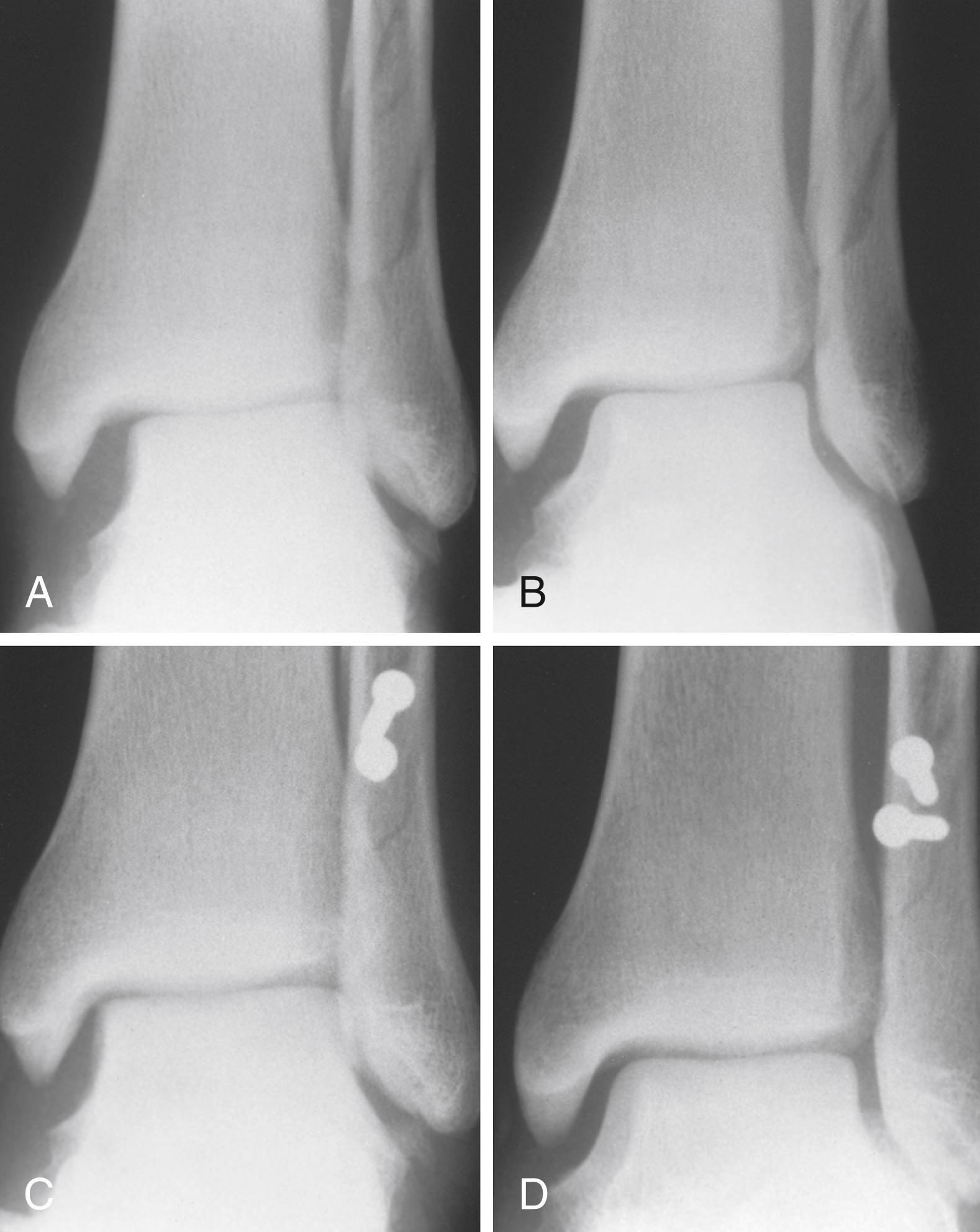 FIGURE 90.10, Tear of deltoid ligament associated with fibular fracture. A, Anteroposterior view shows small fragment off medial malleolus and shift of talus within ankle mortise. B, Oblique view shows widening of joint space on medial side of ankle. C and D, Open reduction and internal fixation of fracture of lateral malleolus, with reduction of talus into ankle mortise; deltoid ligament was not repaired.