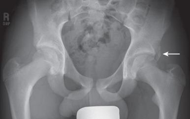 Figure 144.1, A 15-year-old boy with left anteroinferior iliac spine avulsion fracture (arrow) related to the rectus femoris origin.