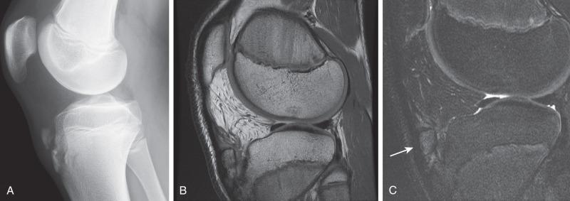 e-Figure 144.11, Osgood-Schlatter disease in a 15-year-old.