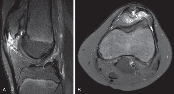 e-Figure 144.12, Partial patellar tendon tear.