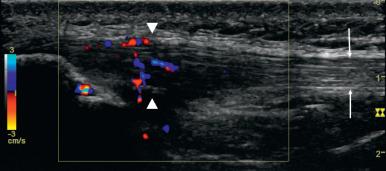 e-Figure 144.13, Proximal patellar tendinopathy (jumper's knee) in a 17-year-old male.