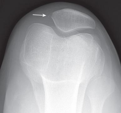 Figure 144.14, Acute patellar dislocation/relocation in an 18-year-old.