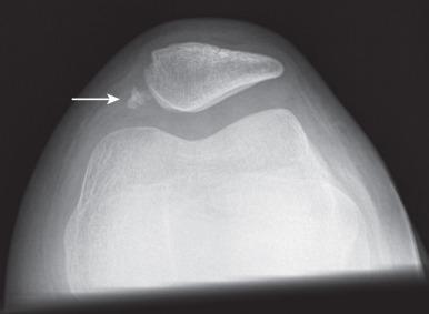 e-Figure 144.15, Old avulsion fracture fragments caused by prior patellar dislocation in an 11-year-old girl.