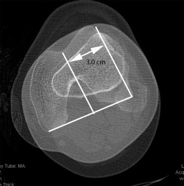 e-Figure 144.17, Tibial tubercle-trochlear groove (TT-TG) distance.