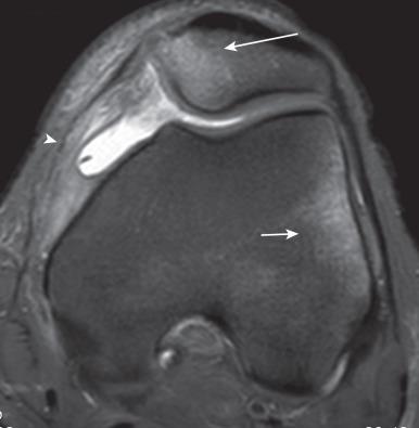 Figure 144.18, Lateral patellar dislocation with characteristic kissing contusions in a 19-year-old.