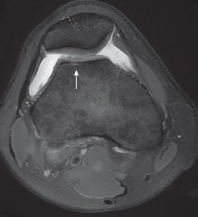 Figure 144.19, Patellofemoral dysplasia in a 16-year-old boy.