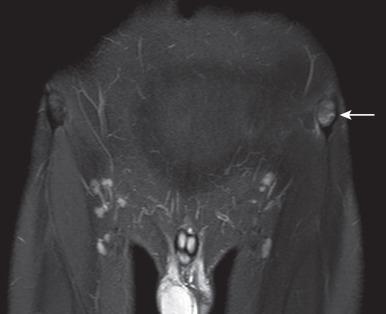 e-Figure 144.2, Nondisplaced left anterosuperior iliac spine avulsion fracture in a 16-year-old boy.