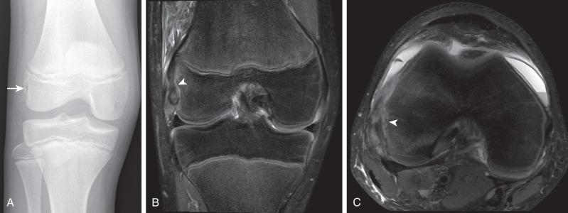 Figure 144.3, Popliteus origin chondro-osseous avulsion fracture in a 13-year-old boy.