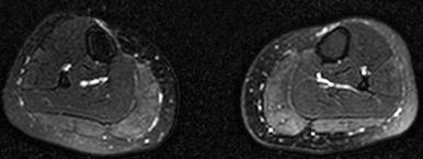 Figure 144.4, Delayed onset muscle soreness in an adolescent.