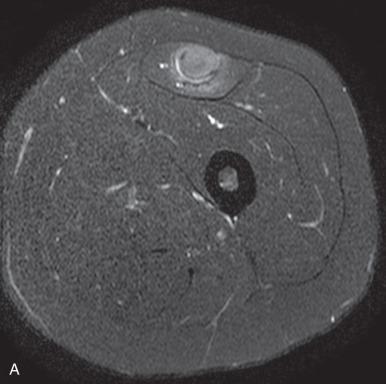 Figure 144.6, Intramuscular degloving type injury of the rectus femoris musculotendinous junction in a 17-year-old female.