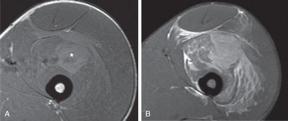 e-Figure 144.5, Vastus intermedius direct muscle contusion in a 17-year-old boy.