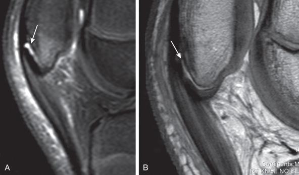 Figure 144.7, Patellar sleeve avulsion in a 12-year-old boy.