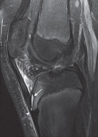 Figure 144.9, Acute minimally displaced partial tibial tuberosity avulsion fracture (arrow) on a sagittal T2-weighted fat suppression MR image from a 13-year-old boy.