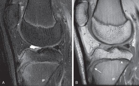 Figure 144.10, Tibial tuberosity avulsive injury in a 14-year-old girl.