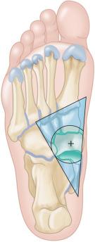 Fig. 116.2, Plantar aspect of the bones of the right foot showing primary support region for the longitudinal arch support mechanism of a foot orthosis. Partial circle indicates the position of the vertices of the orthotic support.