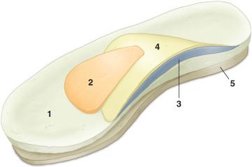 Fig. 116.3, Right angular front view of basic insole with components. 1, Basic insole; 2, metatarsal dome; 3, “normal” arch support; 4, “extra” arch support; and 5, wedge (medial).