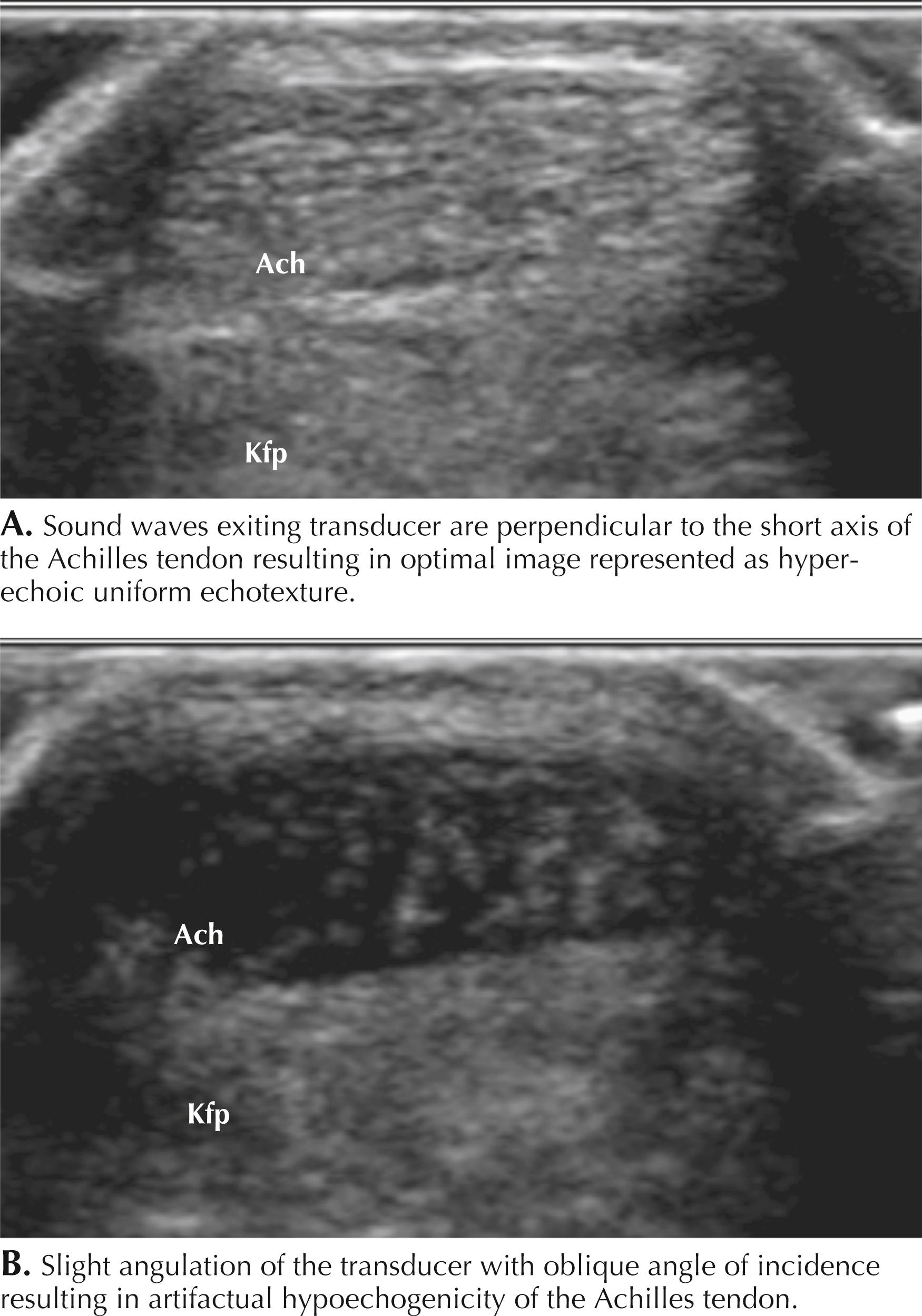 Figure 64.1, Anisotropy. Ach, Achilles tendon; Kfp, Kaeger fat pad.