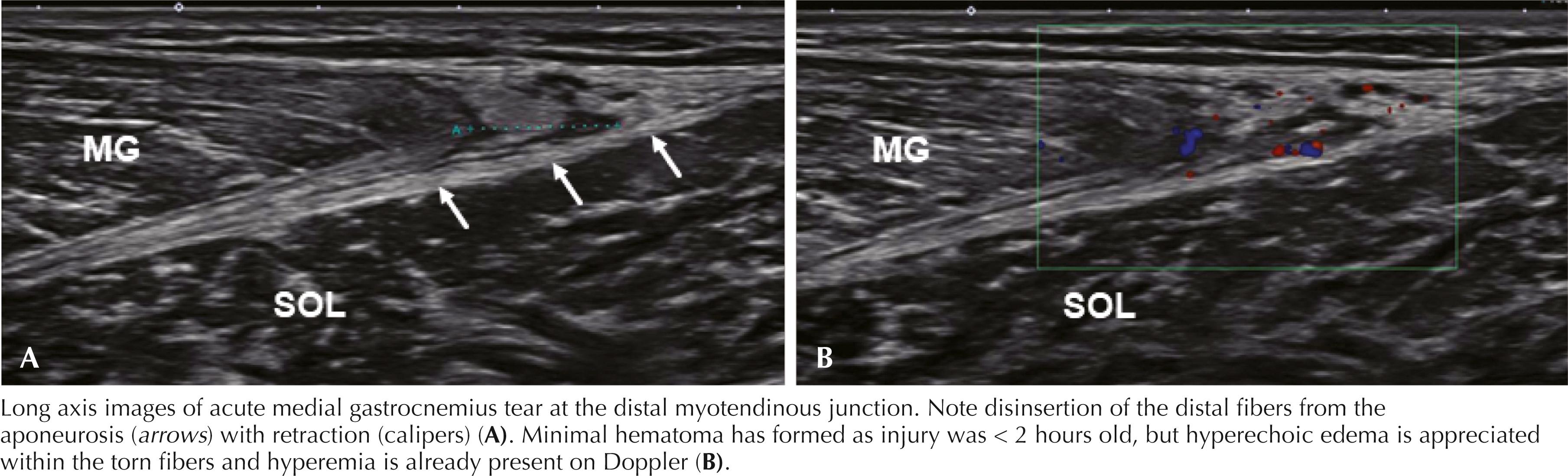 Figure 64.13, Medial gastrocnemius muscle tear. MG, Medial gastrocnemius; SOL, soleus.