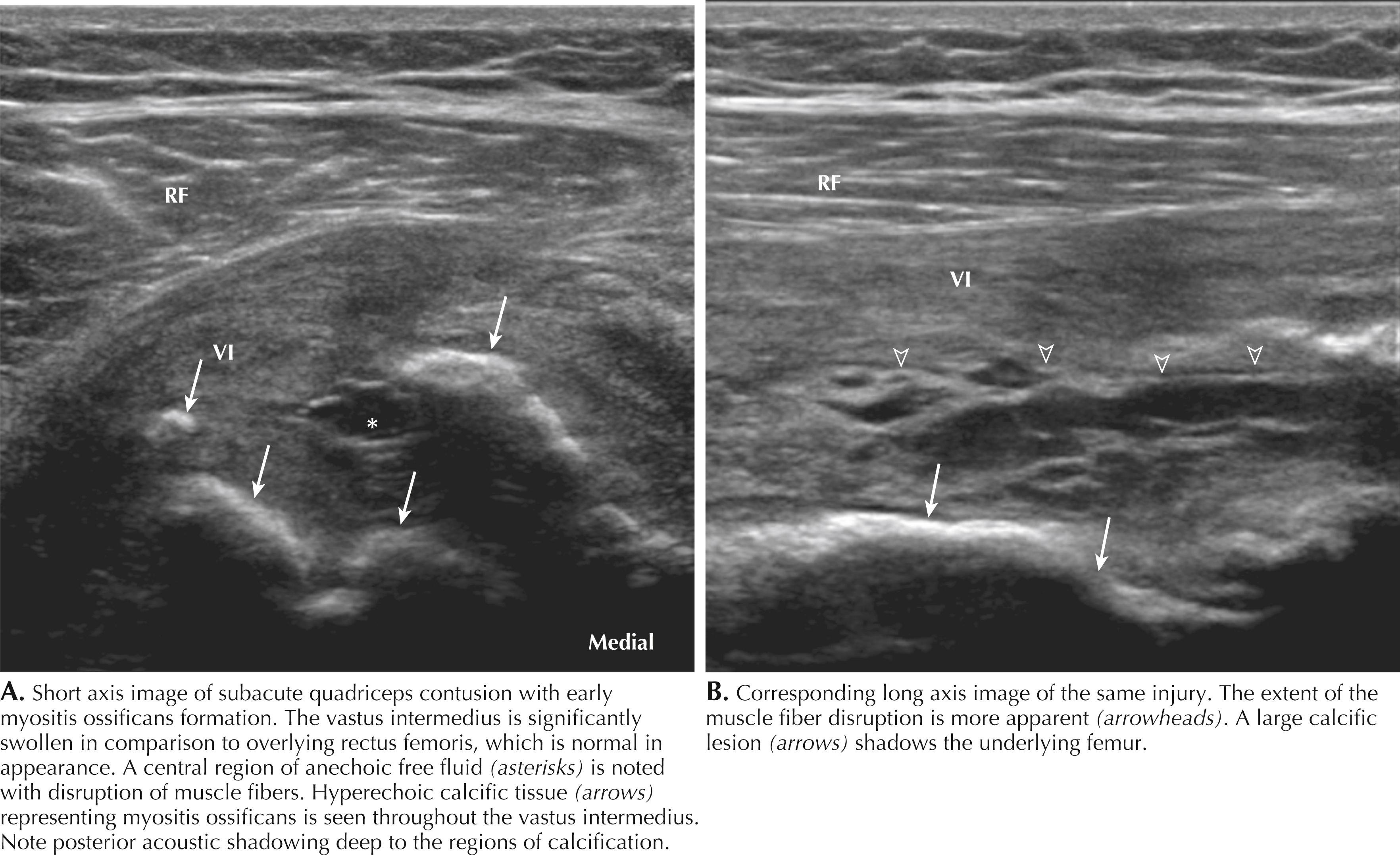 Figure 64.14, Quadriceps contusion. RF, Rectus femoris; VI, vastus intermedius.