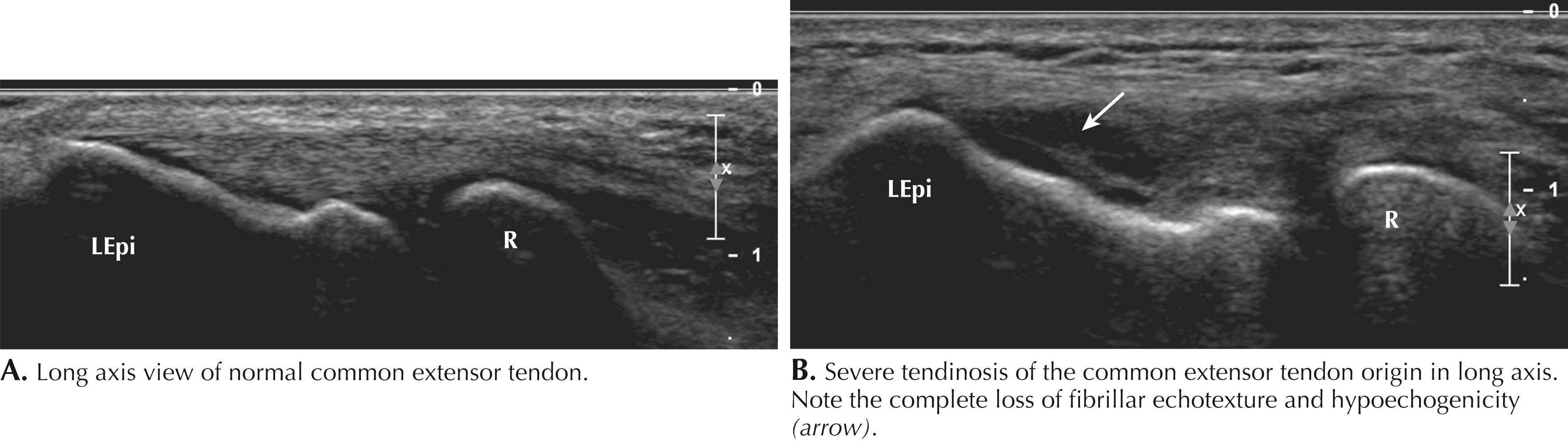 Figure 64.4, Common extensor tendinopathy. LEpi, Lateral epicondyle; R, radius.