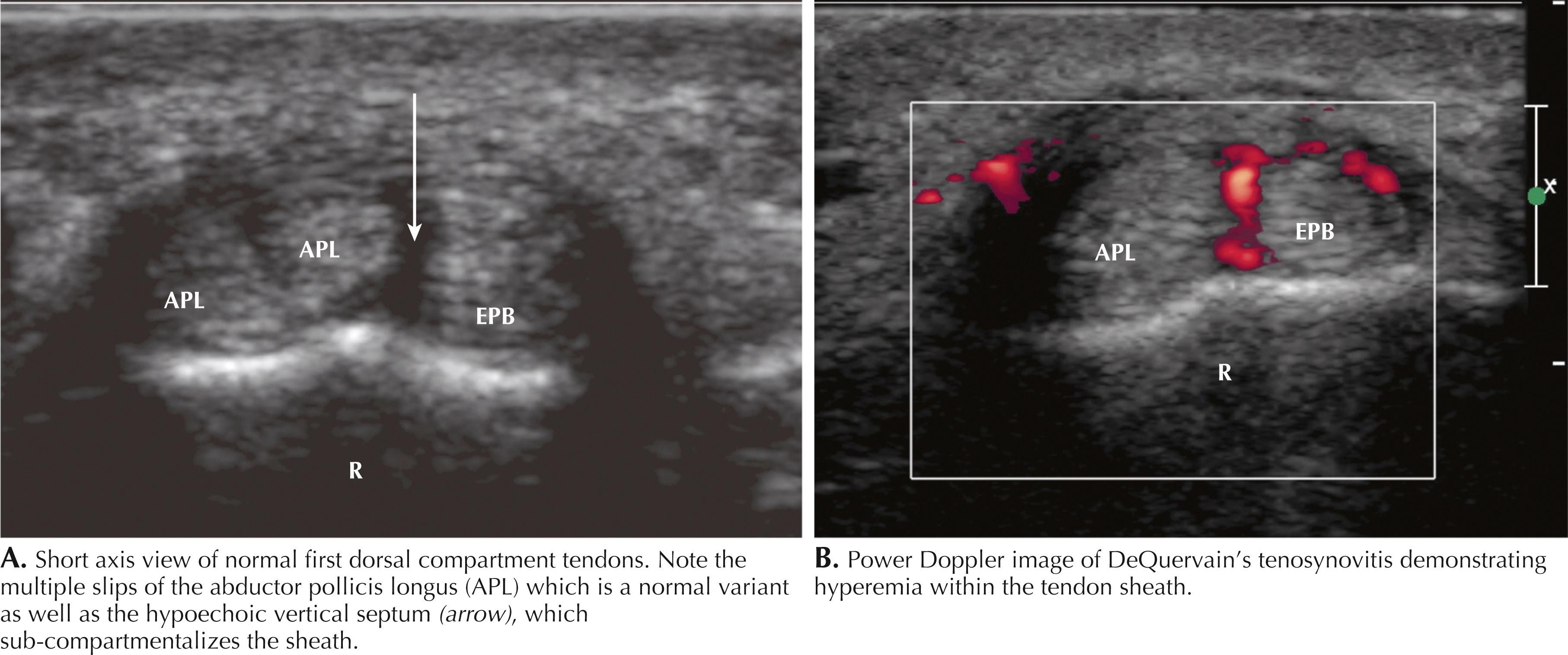 Figure 64.5, De Quervain tenosynovitis. APL, Abductor pollicis longus; EPB, extensor pollicis brevis; R, radius.