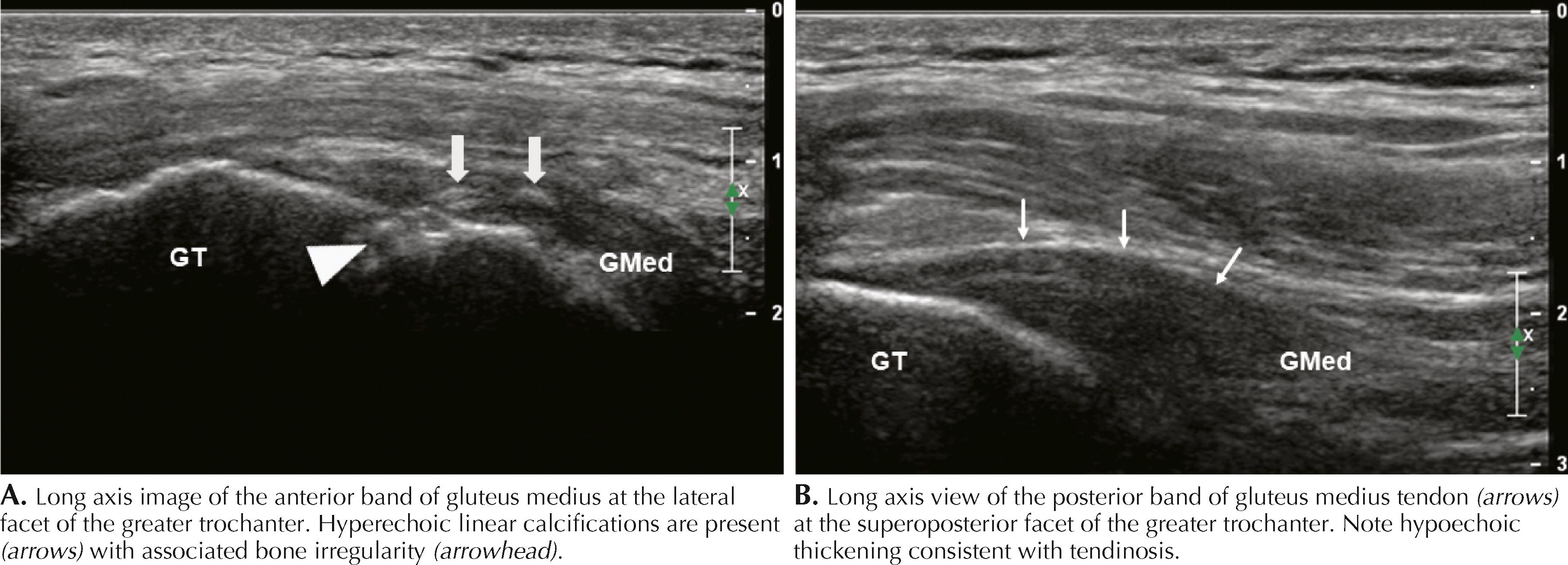 Figure 64.6, Gluteus medius tendinopathy. GMed, Gluteus medius tendon; GT, greater trochanter.