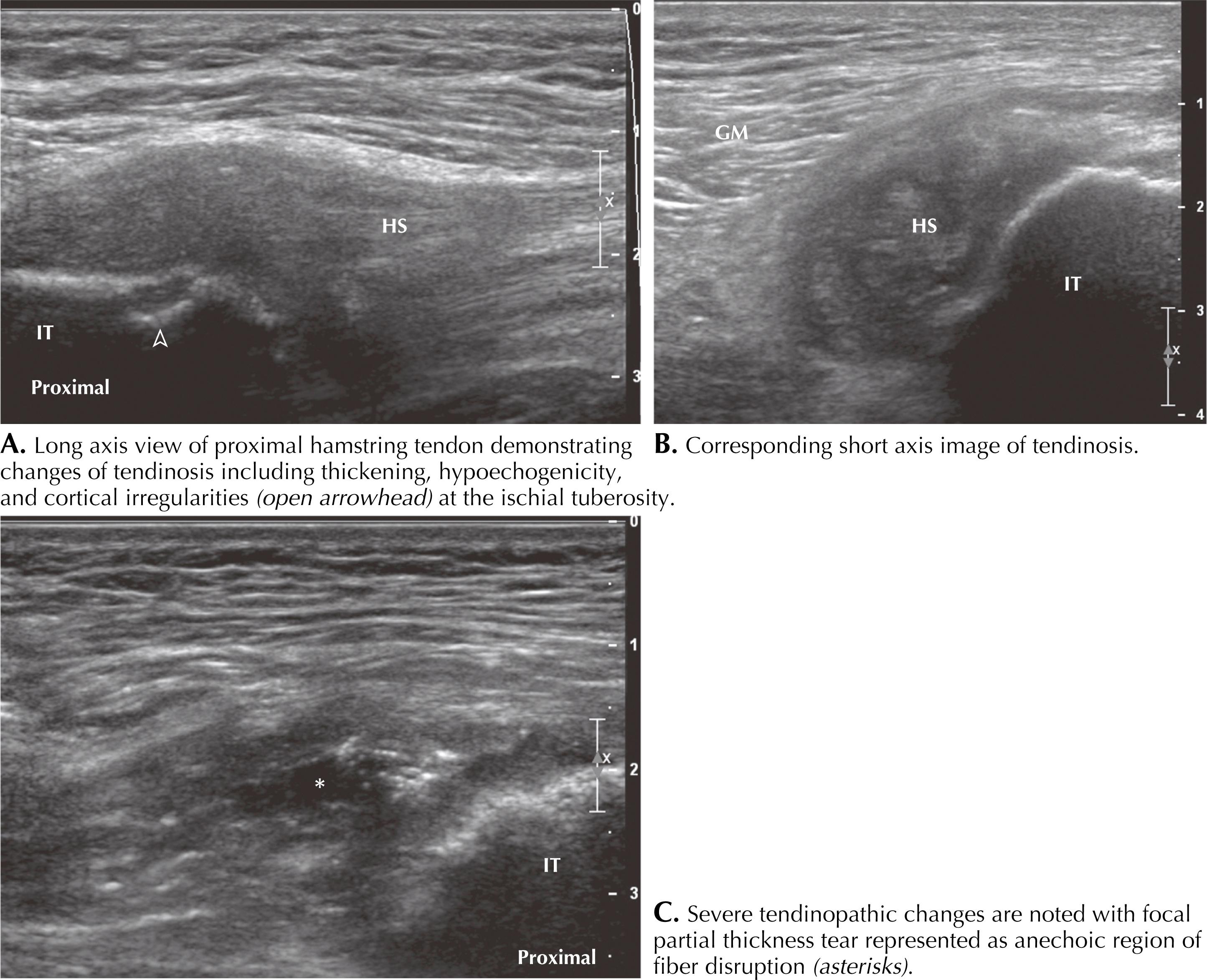 Figure 64.7, Proximal hamstring tendinopathy. GM, Gluteus maximus; HS, proximal hamstring tendon; IT, ischial tuberosity.