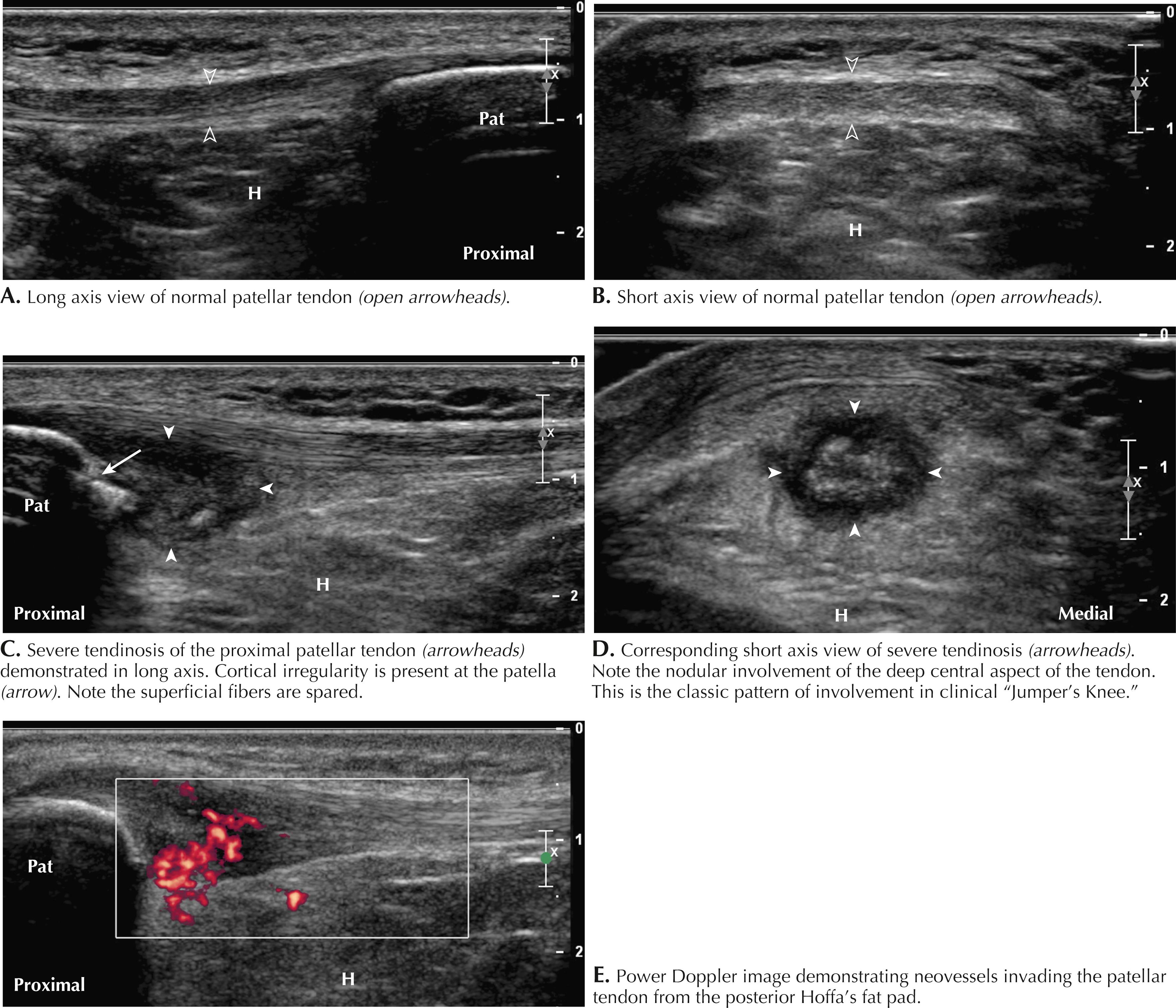 Figure 64.8, Patellar tendinopathy. H, Hoffa fat pad; Pat, patella.