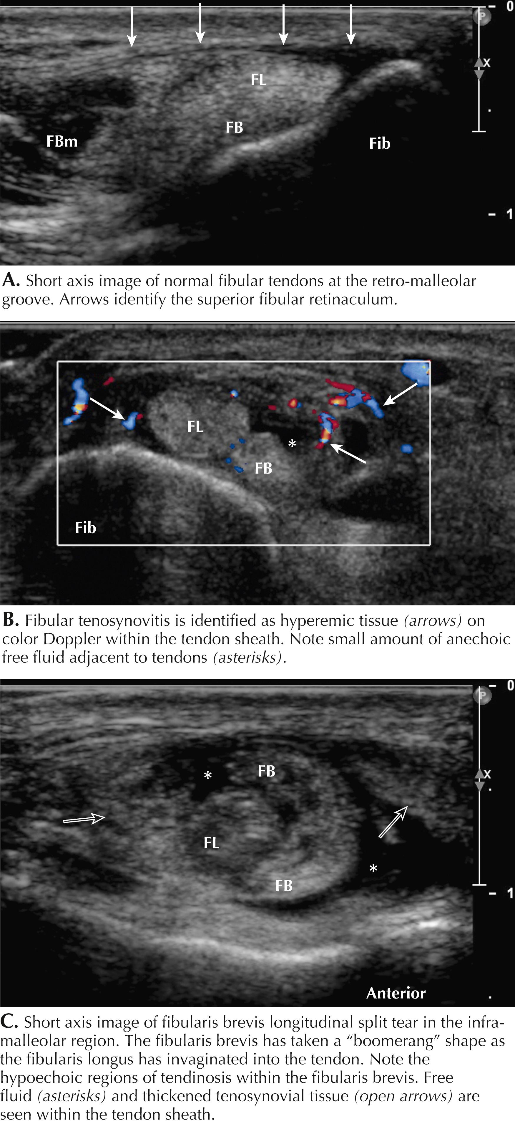 Figure 64.9, Fibular (peroneal) tendinopathy. FB, Fibularis brevis; FBm, fibularis brevis muscle. Fib, fibula; FL, fibularis longus.