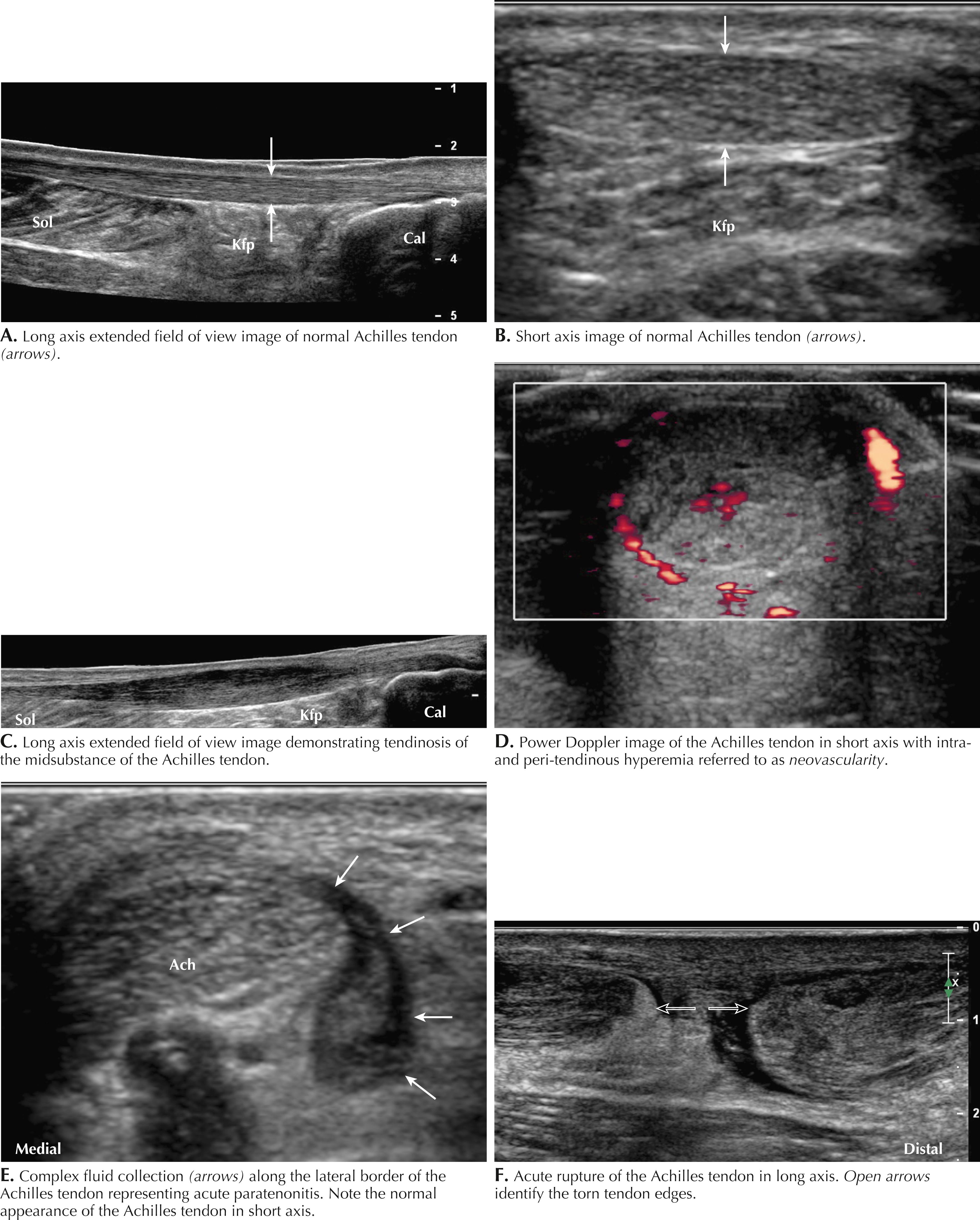 Figure 64.10, Achilles tendinopathy. Asterisk indicates retrocalcaneal bursa. Cal, Calcaneus; Kfp, Kaeger fat pad; Sol, soleus.