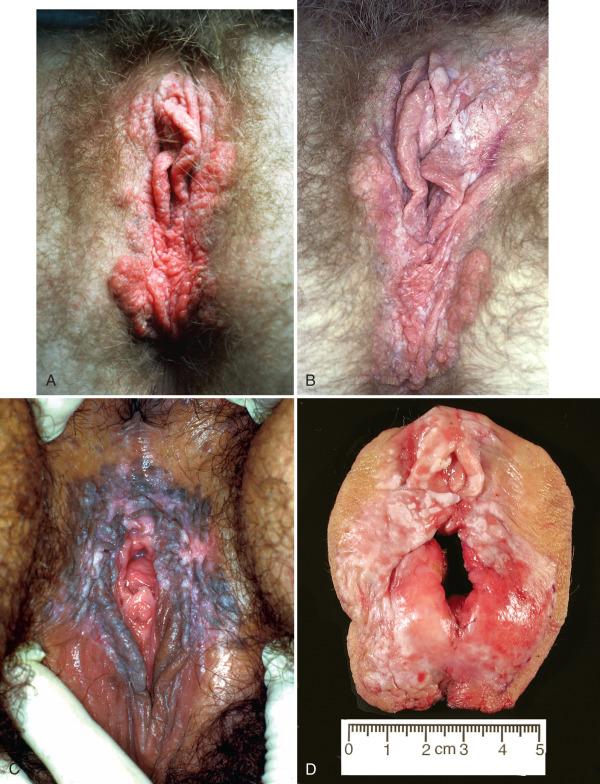 Fig. 6.11, Clinical presentations of classic vulvar intraepithelial neoplasia (VIN). A and B, Raised irregular lesions with variable hyperkeratosis. C, More macular pigmented VIN. D, Extensive confluent white plaques.