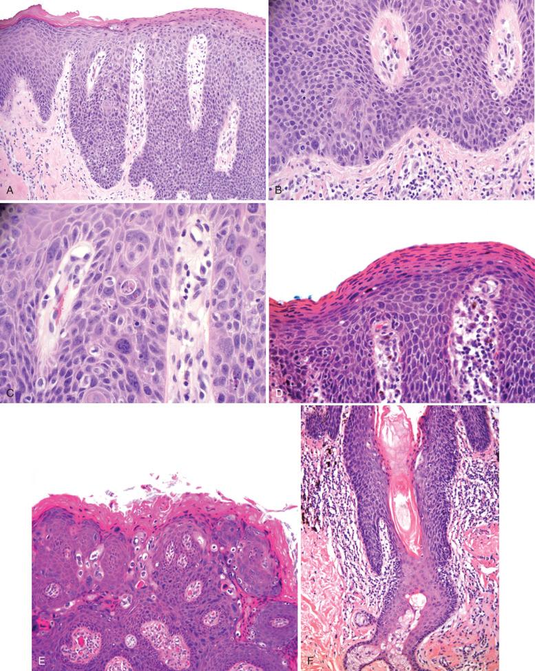 Fig. 6.12, Microscopic features of classic vulvar intraepithelial neoplasia (VIN) (high-grade squamous intraepithelial lesion [HSIL]). A, Junction of non-neoplastic (left) and neoplastic (right) epithelium. There is full-thickness atypia with minimal maturation, characteristic of carcinoma in situ (VIN III). B, The basal third exhibits marked nuclear atypias with anisokaryosis, pleomorphism, and variable nuclear staining. Note the abnormal mitosis (arrow). C, A higher magnification showing apoptosis. D, Dense parakeratosis on the surface of a classic VIN. E, A condylomatous HSIL. F, Skin appendage involvement by classic VIN.