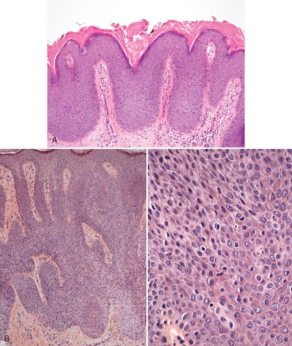 Fig. 6.13, Some vulvar intraepithelial neoplasias (VINs) are more difficult to classify. A, Full-thickness mild atypia akin to Bowenoid papulosis. B and C, A basaloid pattern associated with human papillomavirus (HPV)-16 but with marginal atypia, similar to descriptions of “Bowenoid dysplasia.”