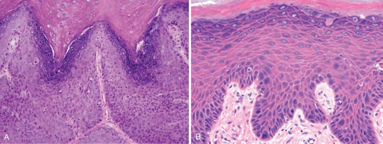 Fig. 6.14, A and B, Classic or usual vulvar intraepithelial neoplasias (VIN) with features of lichen simplex chronicus (LSC). Note the prominent maturation with keratohyaline granules. The lesion depicted in A is consistent with high-grade squamous intraepithelial lesion (HSIL). On the other hand, B is more subtle and difficult to grade.