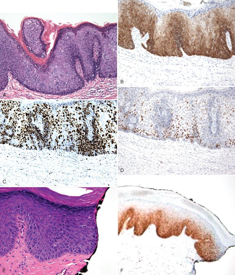 Fig. 6.16, Biomarkers in the diagnosis of classic vulvar intraepithelial neoplasias (VIN). A, H&E shows acanthosis with loss of cell polarity and conspicuous nuclear atypia throughout the entire thickness of the epithelium. B, Strong cytoplasmic and nuclear transepithelial p16 staining. C, Strong but heterogeneous staining in inflamed non-lesional epithelium for comparison. D, Strong MIB-1 staining of HSIL throughout the entire epithelial thickness. E, Margin with equivocal atypia. F, Following p16 immunostaining, which confirms lesion at the margin.