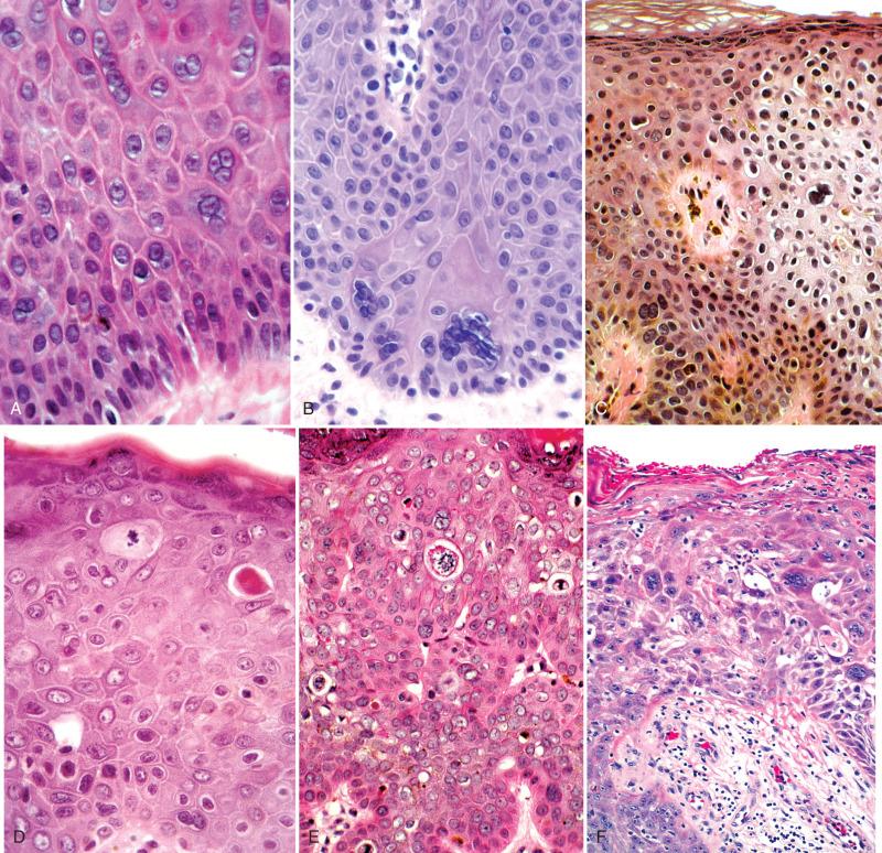 Fig. 6.17, Differential diagnosis of classic vulvar intraepithelial neoplasias (VIN). A and B, Multinuclear atypia, with polynucleation. Note the normal nuclear size and chromasia of the cells and the absence of surrounding atypia. C, Polynucleation in VIN for comparison. D, Pseudo-Bowenoid papulosis with prominent apoptosis. E, Apoptosis in VIN. F, Herpes zoster with multinucleated cells and inconspicuous inclusions may mimic classic VIN.