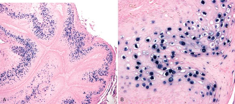 Fig. 6.3, Localization of low-risk human papillomavirus (HPV) nucleic acids in a condyloma. A, Low-power photomicrograph shows a predominant distribution in upper cell layers. B, Most intense staining in superficial keratinocytes, including koilocytes.