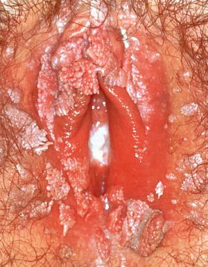 Fig. 6.4, Clinical appearance of vulvar condylomata. Multiple discrete lesions are present.