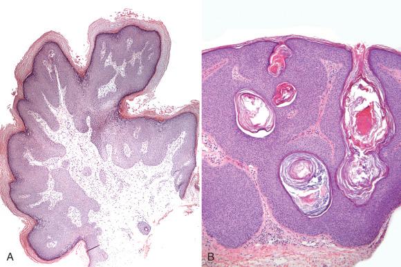 Fig. 6.6, Vulvar condylomata may exhibit a range of appearances, including (A) fibroepithelial papillomas and (B) seborrheic keratosis-like lesions. These are less likely to contain human papillomavirus (HPV) in older women.