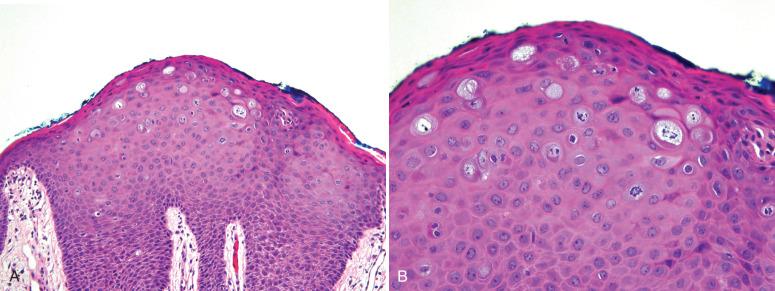 Fig. 6.8, A and B, Pseudo-Bowenoid papulosis. This variant of condyloma has the characteristic architecture of a condyloma with minimal atypia in the lower epithelium; however, the superficial cells exhibit minimal koilocytosis and are distinguished by various stages of apoptosis, including pseudomitoses (center). Note that the uninvolved cells in the lower part of the image display no atypia.