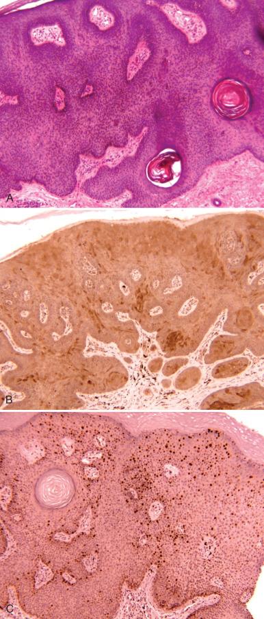 Fig. 6.9, Biomarkers in the diagnosis of low-grade vulvar intraepithelial lesions. A, Seborrheic keratosis-like condyloma. B, Staining of p16 is patchy, consistent with the presence of a low-risk human papillomavirus (HPV). C, Focal staining for MIB-1 is present in the upper layers, characteristic of a variant of condyloma.