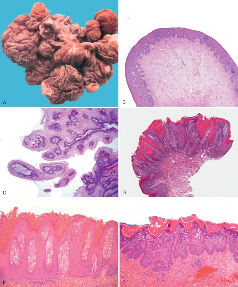 Fig. 6.10, Differential diagnosis of condyloma. A and B, Fibroepithelial stromal polyps (FSPs) lack complex epithelial architecture. C, Introital villiform polyps similarly lack atypias and are considered remnants of hymenal ring. D and E, Verruciform xanthomas display regular papillary architecture with surface dyskeratosis and foamy histiocytes. F, Epidermolytic dyskeratoses have verruciform morphology and prominent surface keratohyaline changes but display no atypia. These are typically discovered incidentally in vulvar specimens.