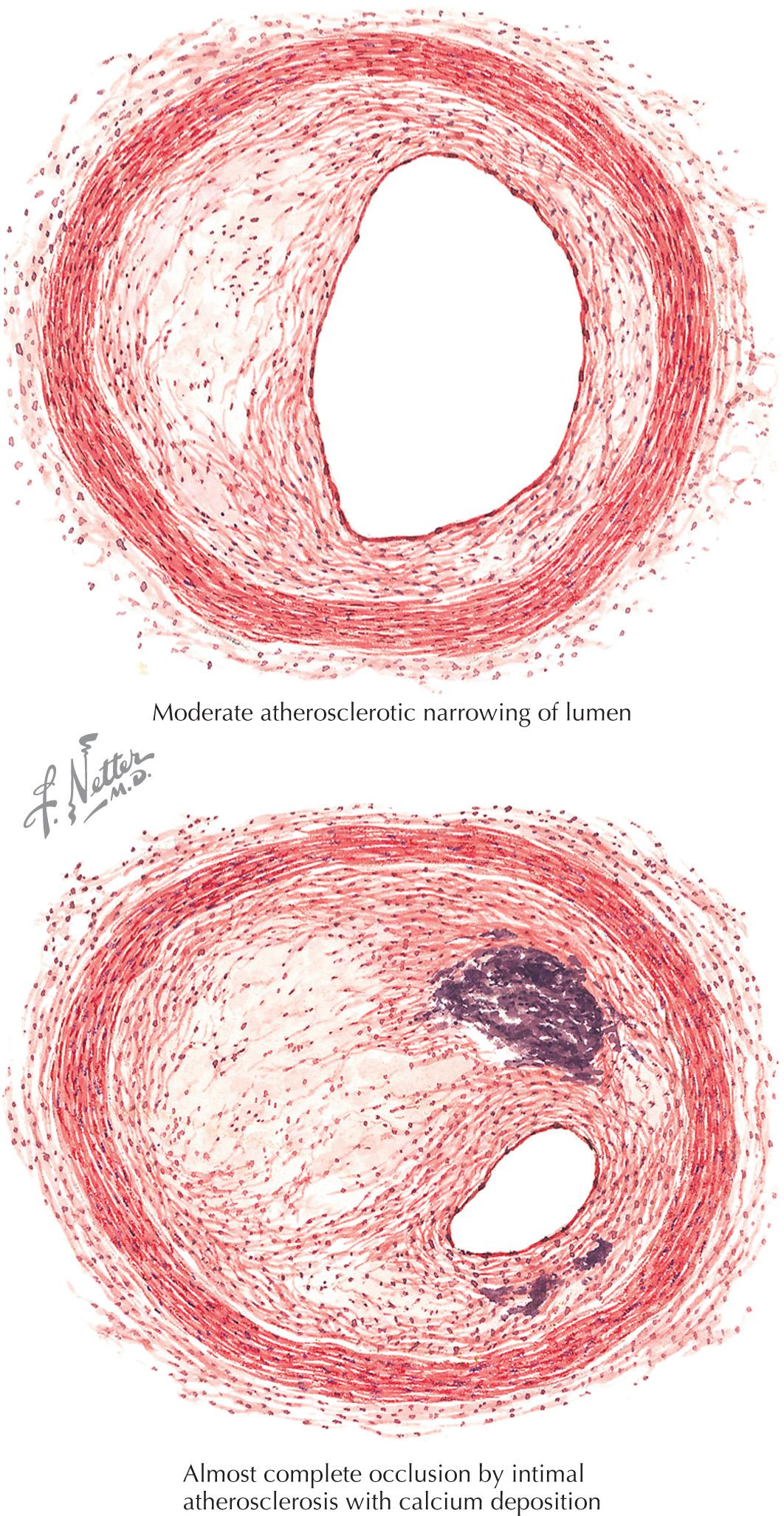 FIG 19.2, Types and Degrees of Coronary Atherosclerotic Narrowing or Occlusion.