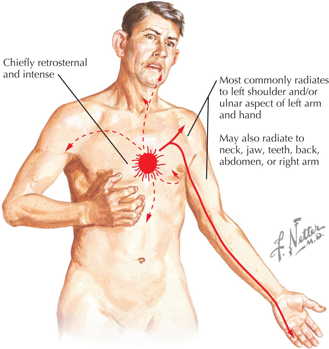 FIG 19.3, Pain of Myocardial Ischemia.